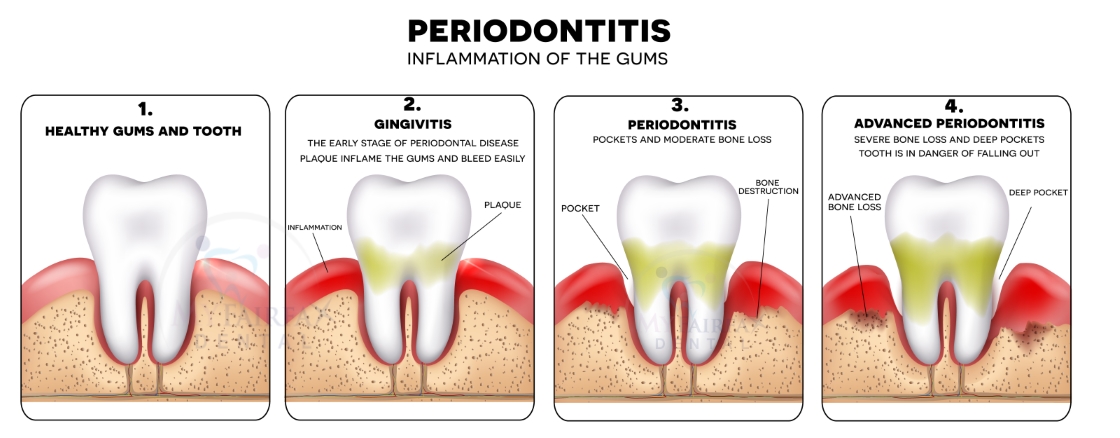 What Is Surgical And Non-surgical Periodontics?
