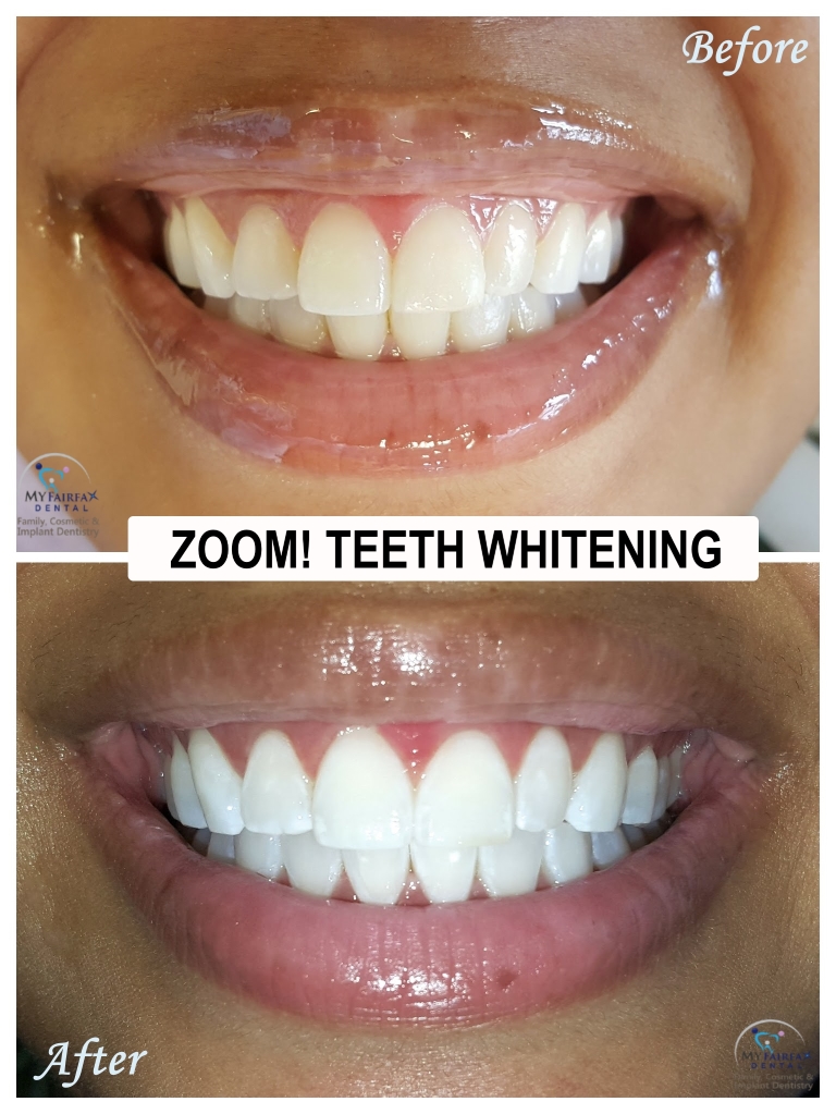 How does teeth whitening at the dentist work